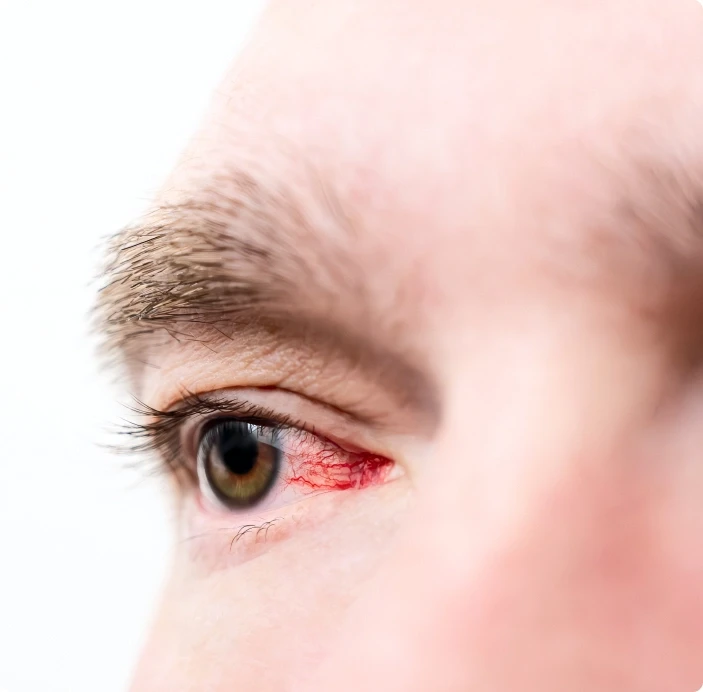 Strabismus treatment