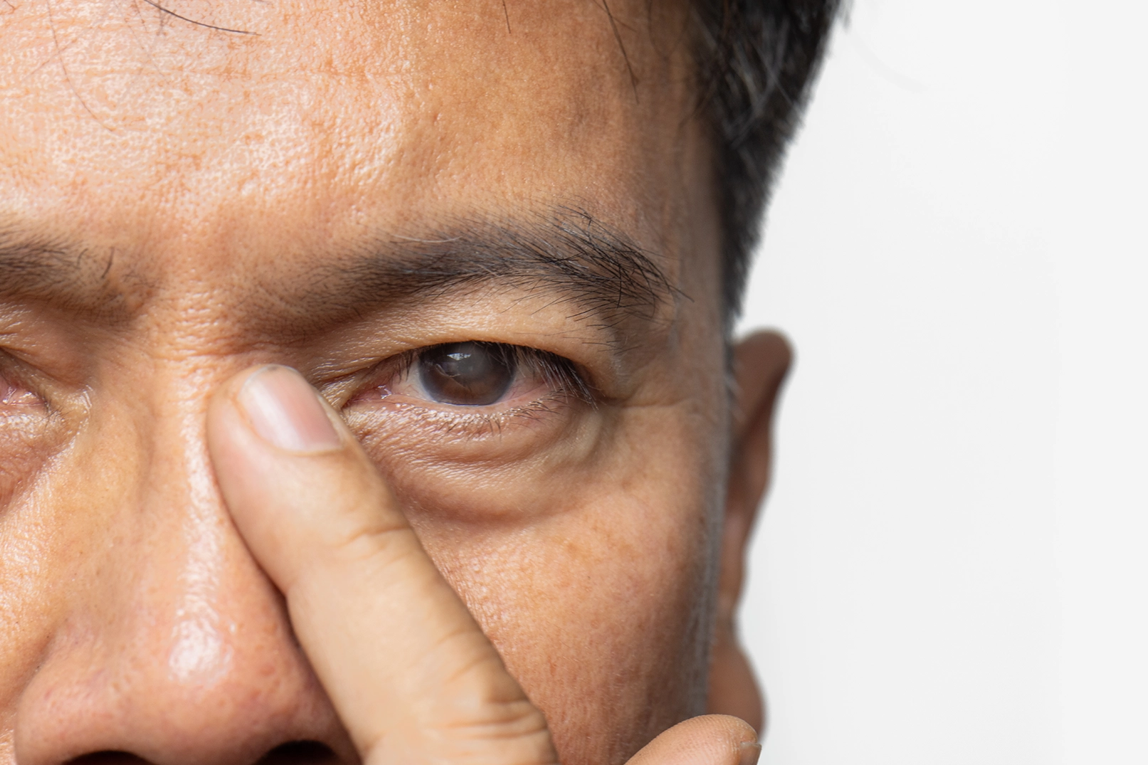 Close up of the eye of a middle-aged man with cataracts