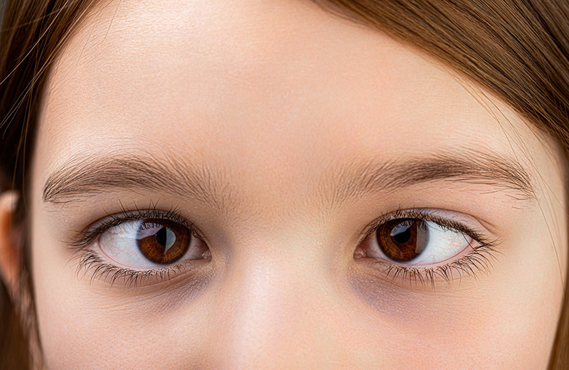 Close-up of a young girl with visible strabismus.
